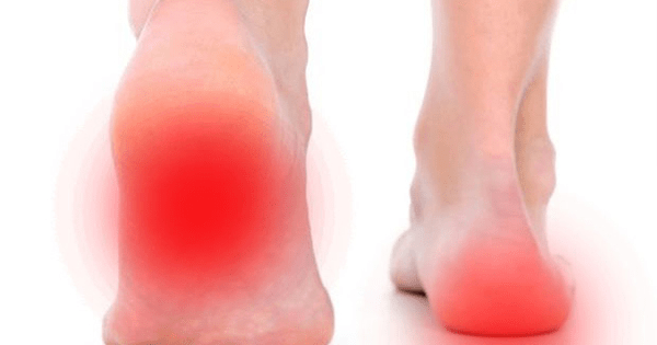 Causas de la fascitis plantar Causas de la fascitis plantar