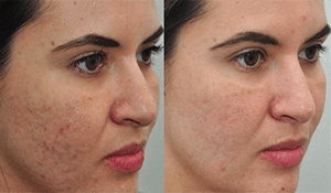 Soluciones para las cicatrices del acné