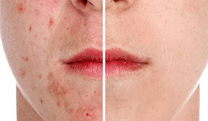 Las cicatrices del acné
