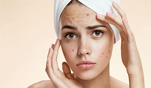 Cómo puedo prevenir el acné