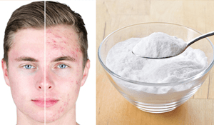 ¿Cómo curar el acné con bicarbonato de sodio?