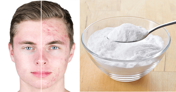 Curar acné con bicarbonato de sodio