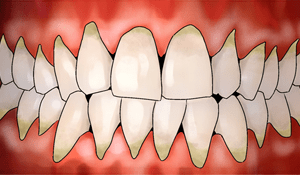 ¿Qué es la periodontitis?