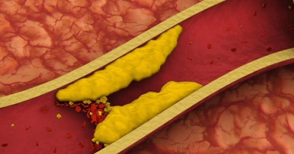 Tratamientos naturales para eliminar el colesterol en la sangre