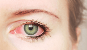 ¿Cómo evitar el Glaucoma?