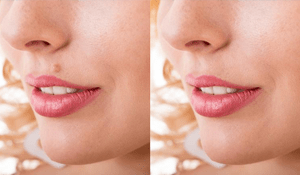 ¿Cómo eliminar las verrugas de la piel sin dejar cicatriz?