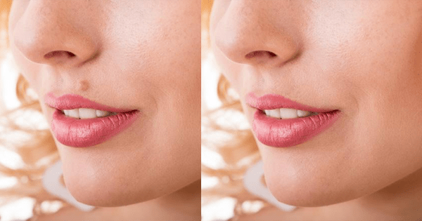 Eliminar las verrugas de la piel sin dejar cicatriz