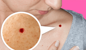 Causas de los puntos rojos en la piel